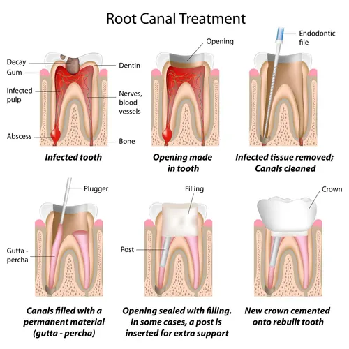 Root canal treatment explained
