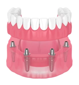 Dentures at Dental1care