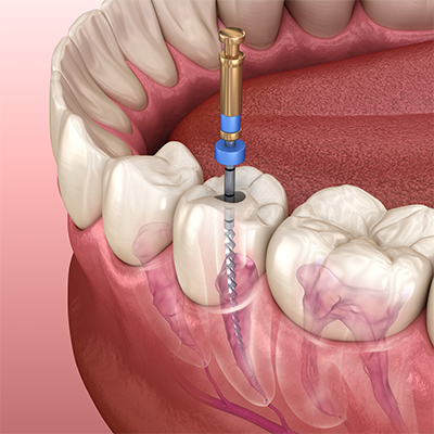 Root canal treatment at dental1care