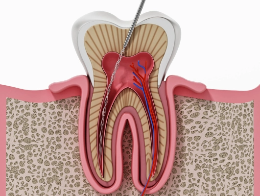 root canal treatment model